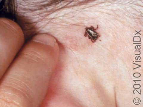 It is important to inspect the skin after being outdoors in wooded or grassy areas. Ticks often hide in obscured areas, such as around the hairline or elsewhere on the scalp.