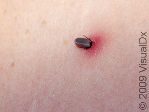 Ticks range in size from extremely tiny and difficult to see to being approximately the size of a pencil eraser.