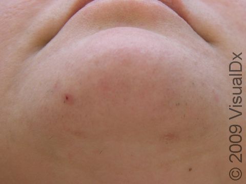 AFTER: Two laser hair removal treatments were performed. This picture is 7 months post treatment.