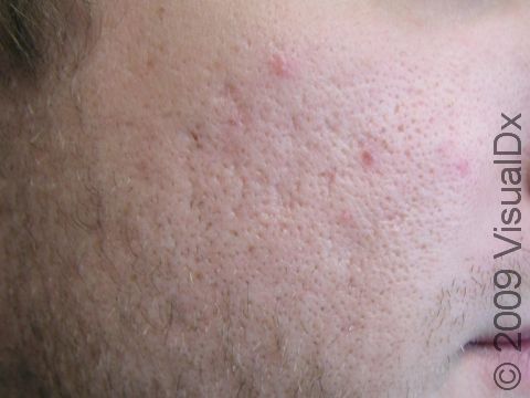 BEFORE: This patient wanted the appearance of his acne scars minimized by laser treatment.