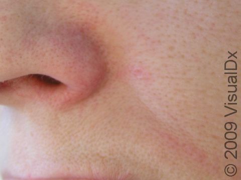 AFTER: A nose immediately after laser treatment for vascular lesions (in this instance, by a long-pulsed Nd:YAG laser).