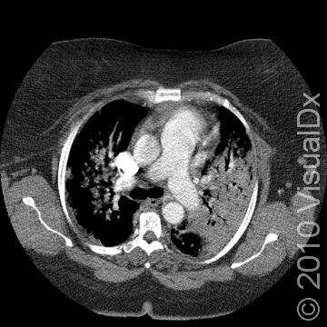 CT scan of chest showing consolidation of the left upper lobe (right side of image) from Legionnaire's disease.