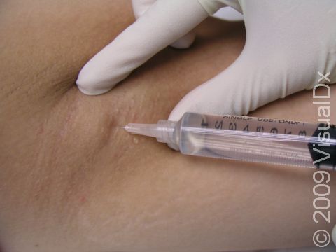 Lidocaine injection, as seen here, is a common anesthesia used to numb a small area of skin prior to undergoing a surgical procedure.