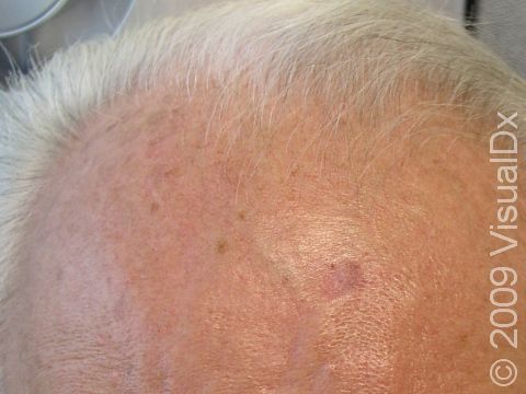 BEFORE: Skin cancer can be seen on the right portion of this patient's forehead. This image was taken prior to Mohs micrographic surgery.