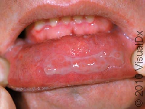 Pemphigus vulgaris frequently affects the inner lining of the mouth (oral mucosa); in this image, there is loss of the top layer of skin (epidermis) of the lip.