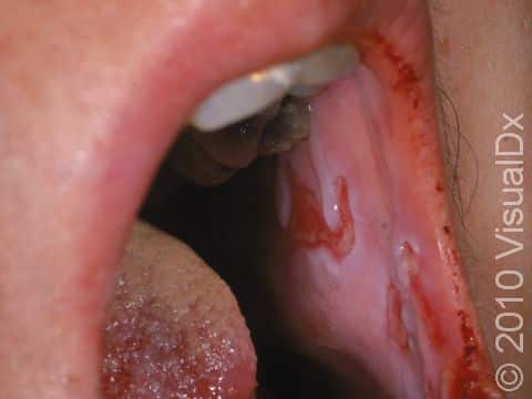 Painful ulcers of the inner lining of the mouth (mucosa of the oral cavity) can occur in pemphigus vulgaris.