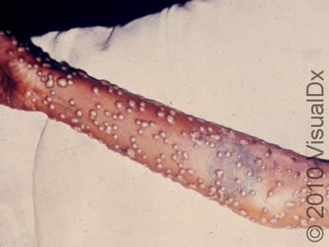 The blisters of smallpox are always at the same stage at the same time.