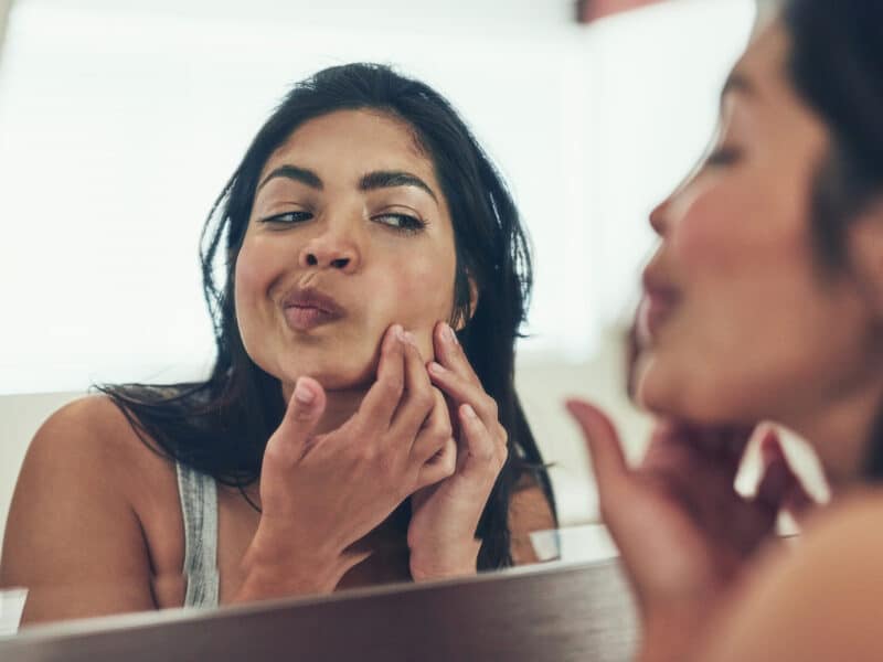 Dealing with Acne: A Beginner’s Guide