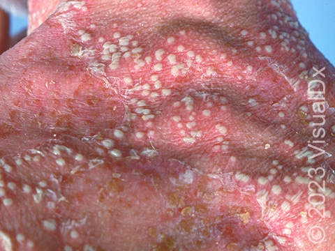 Patients with GPP commonly have large areas of redness with white pustules that become a yellow crust after rupture.