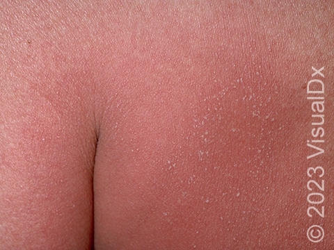 Large areas of redness and tiny pustules on the buttocks in a person with GPP.