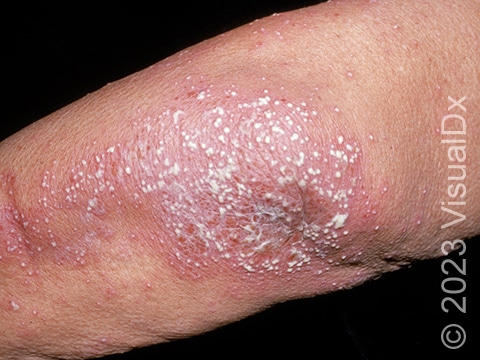 An image of GPP showing a collection of pustules within red, irritated skin on the elbow.