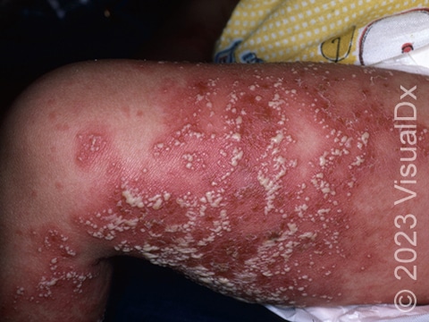 The leg of a patient with classical GPP characterized by prominent pustules within red, irritated skin.