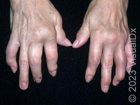 Multiple pink, swollen joints of the hands resulting in deformities of the digits and possible permanent joint destruction.