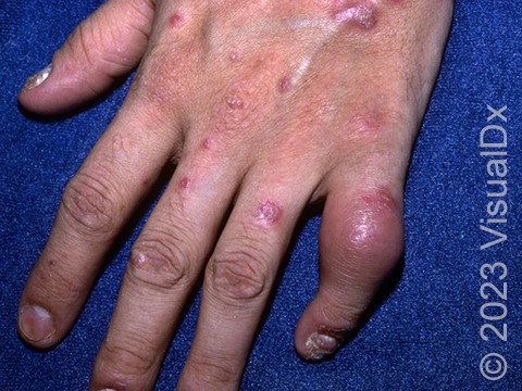 The hand of a plaque psoriasis patient with fingernail changes and a red, swollen pinky finger, both of which correlate strongly with psoriatic arthritis.