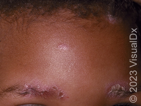 Multiple pink psoriasis plaques on the face and scalp of a child.