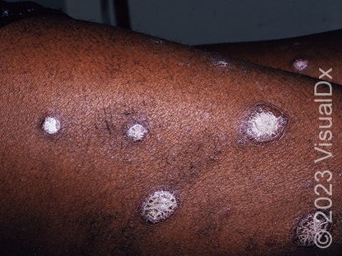 Typical raised, red skin lesions of plaque psoriasis with their characteristic thick white scale. Redness may be subtler in darker skin colors.