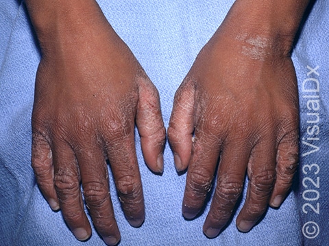 This image shows scaling, thickening, and cracking of the skin in plaque psoriasis affecting the hands and fingers.