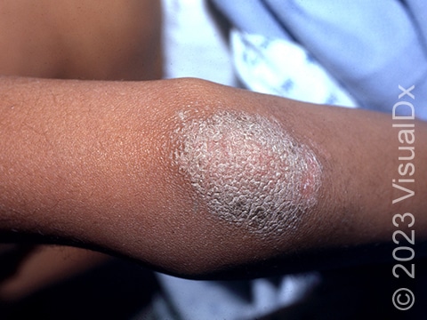 Psoriasis commonly involves areas of the skin where trauma or irritation has occurred. This image shows an elbow lesion in a patient with plaque psoriasis.