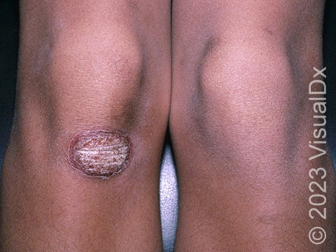 An isolated circular lesion of plaque psoriasis on the knee with compact white scale and red-purple discoloration.