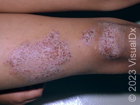Some patients with plaque psoriasis may develop thinner, raised, pink lesions without the classical thick white scale.