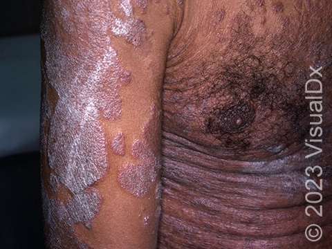 Subtle pink, scaly skin lesions of the ear and scalp of a patient with plaque psoriasis.