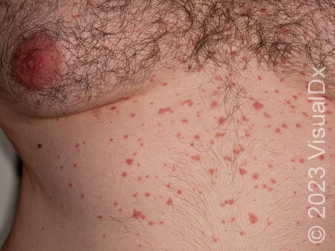 Diffuse, small, red skin lesions with minimal scale, representative of the rash of guttate psoriasis.