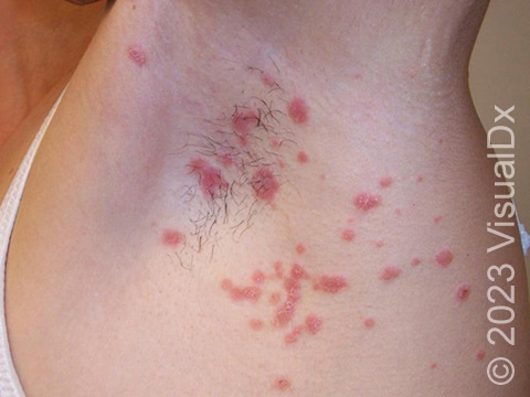 Guttate psoriasis presents on the skin as small circular or oval-shaped red lesions with fine white scale.