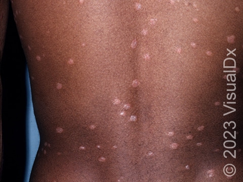 Skin lesions on the trunk of a patient with widespread guttate psoriasis.