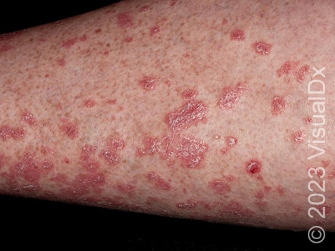 Characteristic raised, red, scaly skin on the leg of a patient with guttate psoriasis.