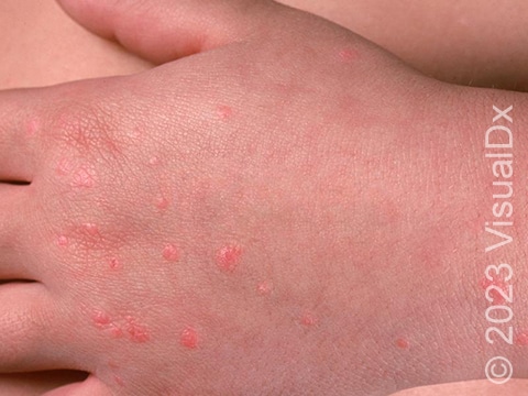 Guttate psoriasis skin lesions on the left hand of a child.