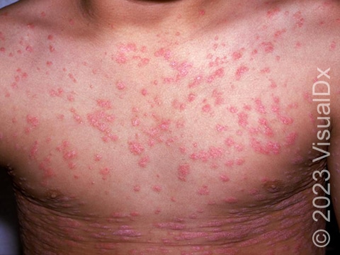 Severe, widespread skin lesions on the trunk of a patient with guttate psoriasis.