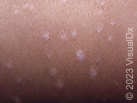 Guttate psoriasis may result in the sudden appearance of multiple scattered red or pink skin lesions with light scale.