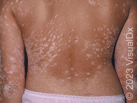 Bacterial infections such as strep throat may trigger the development of guttate psoriasis.
