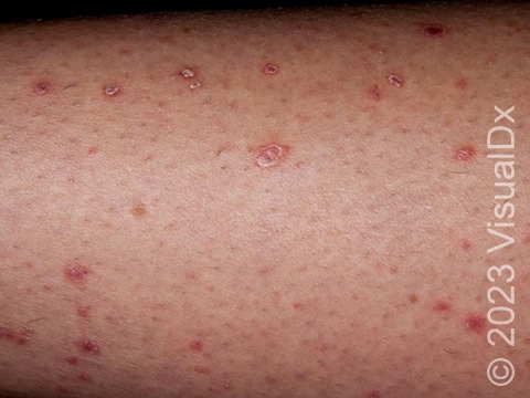 Small red lesions with white scale in a patient with guttate psoriasis.
