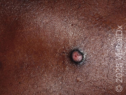 An isolated prurigo nodule (raised bump) of the skin with a hyperpigmented (darkened) base and some central skin breakdown.