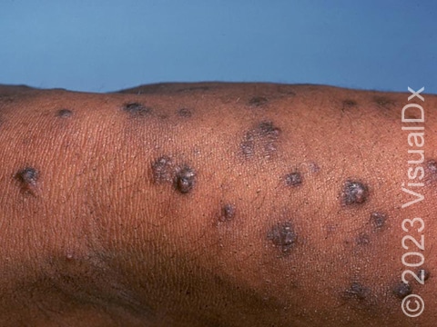 Hyperpigmented nodules (raised, darkened bumps) of the skin in a patient with prurigo nodularis.
