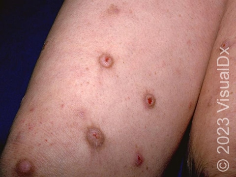 Prurigo nodularis is characterized by itchy nodules (raised bumps), often with central skin breakdown secondary to picking.