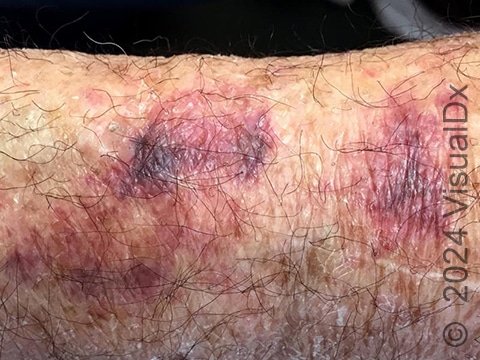 Purple, bruise-like patches on a background of thin, wrinkled, sun-damaged skin on the forearm.